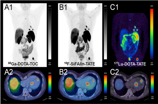 Positronenemissionstomografie Darstellung mit Positronenemissionstomografie